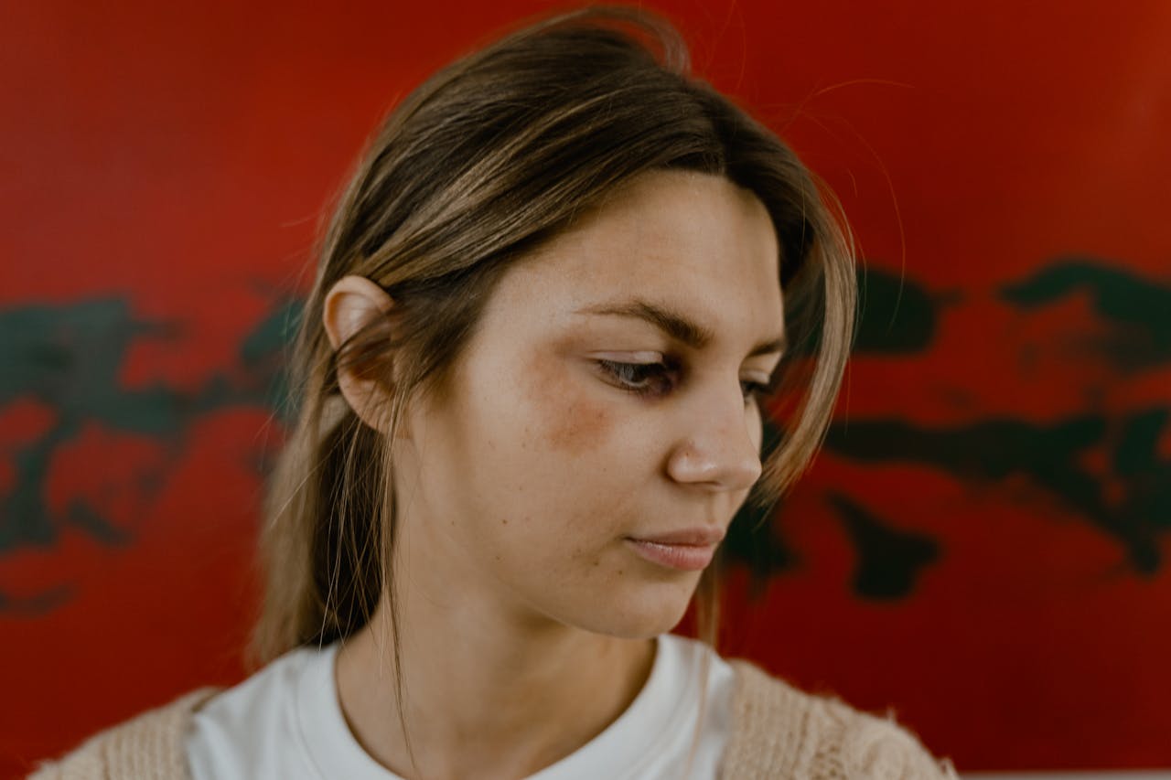 Pijn bij kneuzing wordt erger: waar let je op en wat kun je doen?